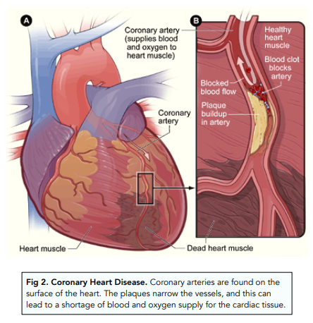 Cardiovascular Disease: Lifestyle and Stents