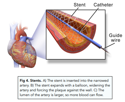 Cardiovascular Disease: Lifestyle and Stents