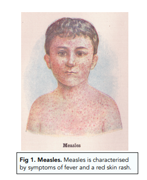 Viral Diseases: TMV, Measles and Ebola
